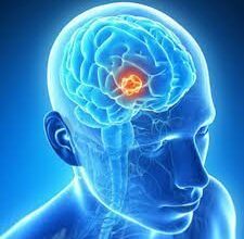 Brain tumor a life-threatening disease but don’t panic